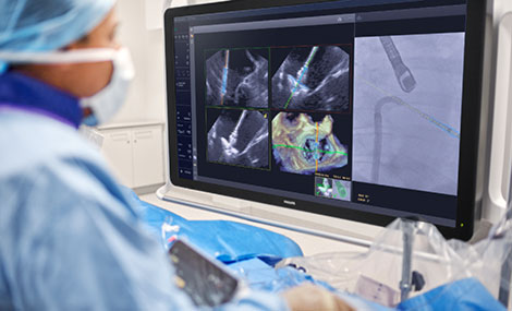 Premiere: Philips bringt KI in den Operationssaal, um Ärzte bei der Rekonstruktion undichter Herzklappen zu unterstützen